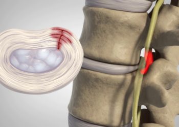 Herniated Disc – Patient Education