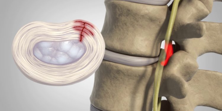 Herniated Disc - Patient Education - Unemployable Graduate